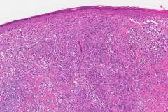 Invasive melanoma, lentigo melanoma type