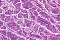 Invasive micropapillary carcinoma of the breast