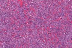 Kaposi sarcoma of the skin
