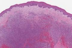 Kaposi sarcoma of the larynx