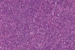 Kaposi sarcoma of the larynx