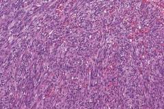 Kaposi sarcoma of the larynx