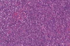 Kaposi sarcoma of the larynx