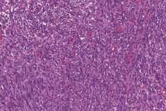 Kaposi sarcoma of the larynx