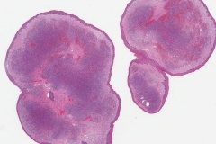 Kaposi sarcoma of the larynx