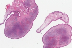 Kaposi sarcoma of the larynx