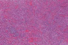 Kaposi sarcoma