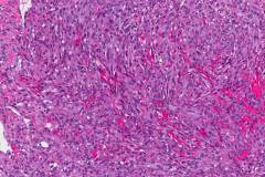 Kaposi sarcoma of the oropharynx
