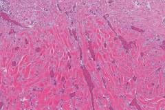 Keloid scar