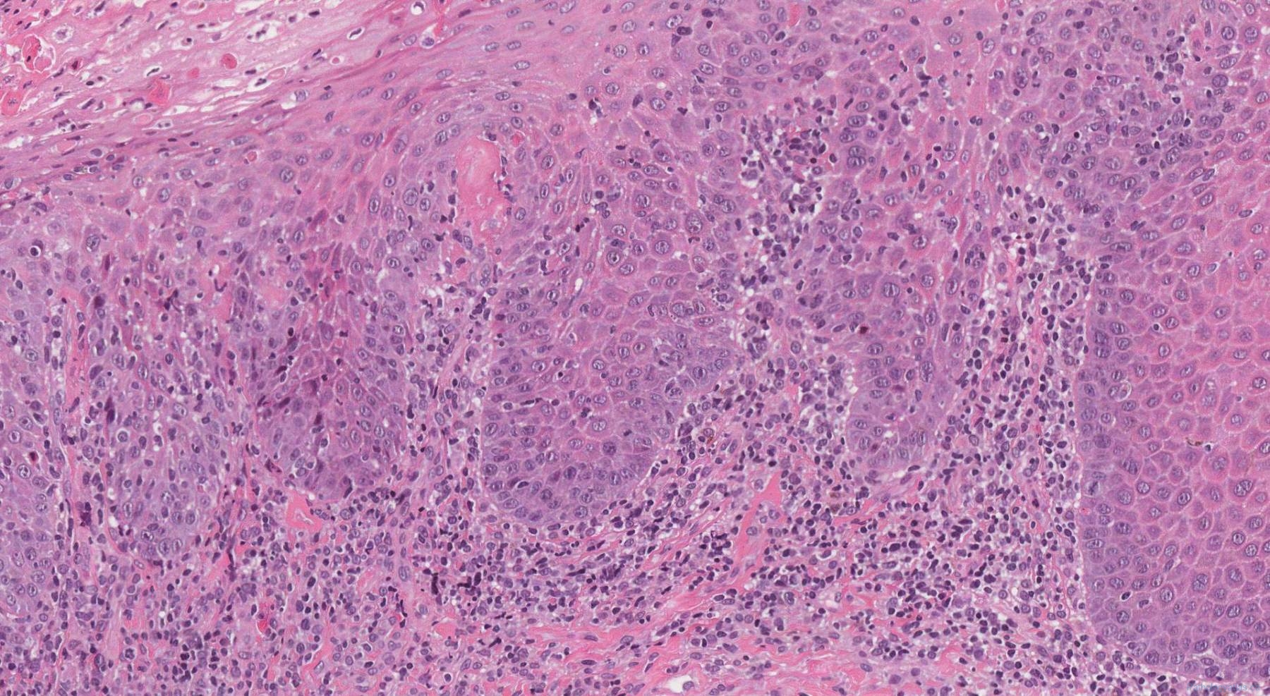 Keratinizing Squamous Dysplasia Of The Oral Cavity Atlas Of Pathology