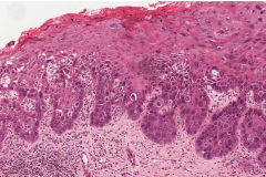 Severe keratinizing squamous dysplasia of the oral cavity