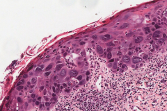 Severe keratinizing squamous dysplasia of the oral cavity