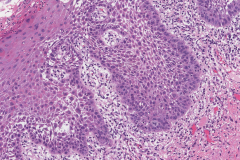 Severe keratinizing squamous dysplasia of the oral cavity