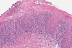 Moderate keratinizing squamous dysplasia in a background of lichenoid mucositis