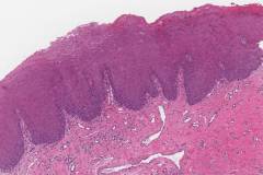 Moderate keratinizing squamous dysplasia of the tongue