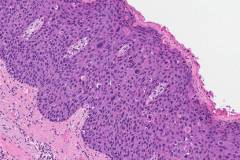 Severe keratinizing squamous cell carcinoma of the oral cavity