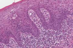 Severe keratinizing squamous dysplasia arising in a background of lichenoid mucositis