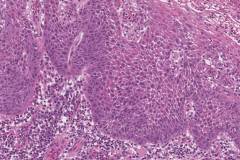 Severe keratinizing squamous dysplasia arising in a background of lichenoid mucositis