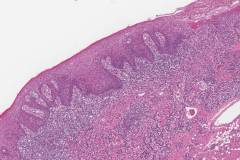 Severe keratinizing squamous dysplasia arising in a background of lichenoid mucositis