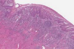 Severe keratinizing squamous dysplasia arising in a background of lichenoid mucositis