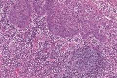 Severe keratinizing squamous dysplasia arising in a background of lichenoid mucositis