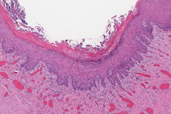 Severe keratinizing squamous dysplasia of the oral tongue