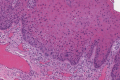 Severe keratinizing squamous dysplasia of the oral tongue