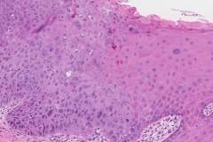 Severe keratinizing squamous dysplasia of the oral cavity