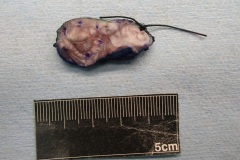 Severe keratinizing squamous dysplasia of the tongue