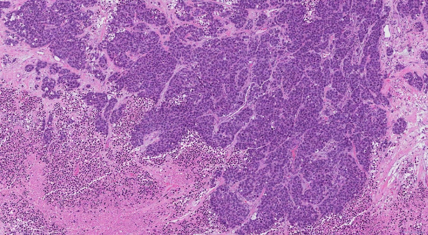 Large Cell Neuroendocrine Carcinoma Of The Lung Atlas Of Pathology