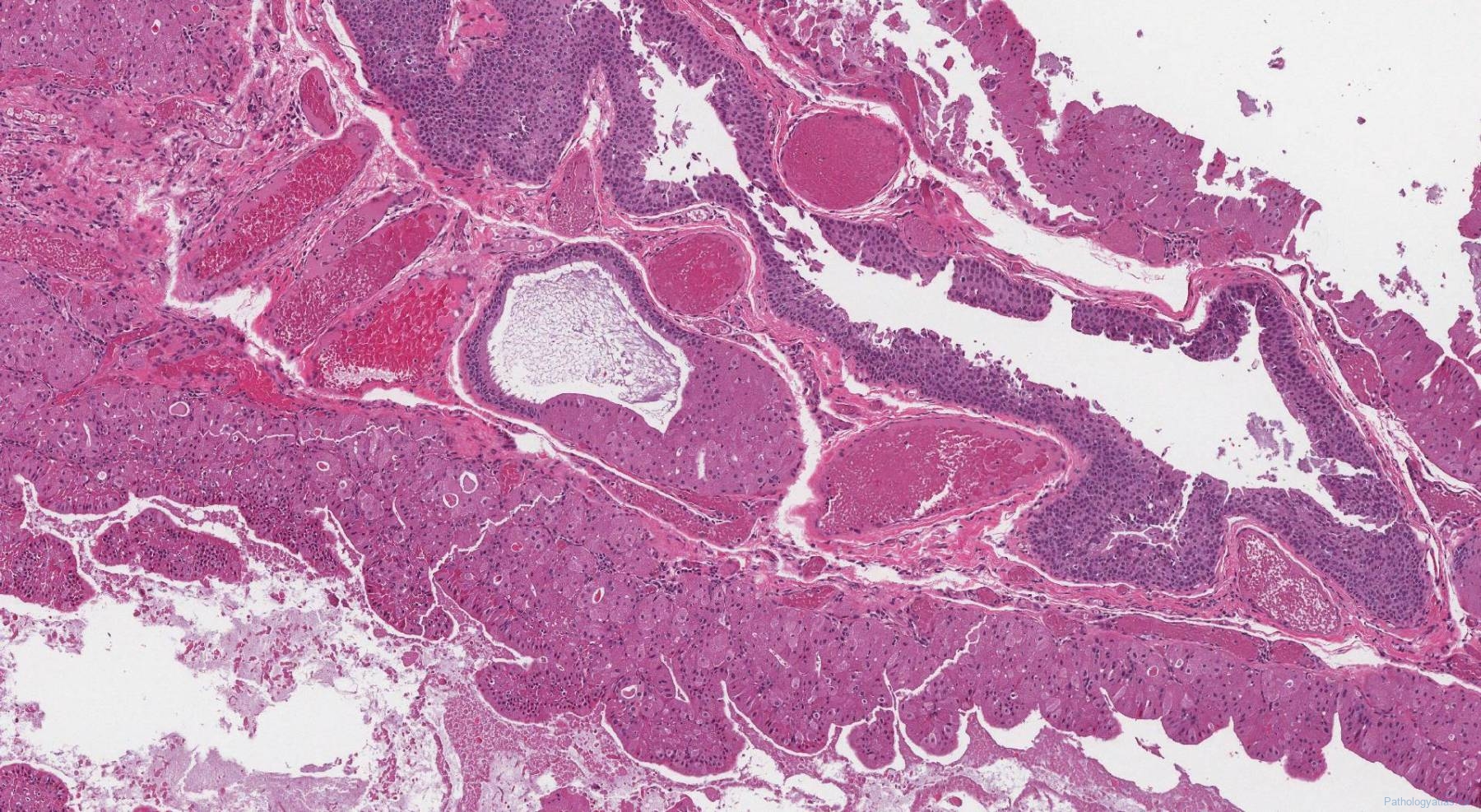 Saccular Cyst Archives Atlas Of Pathology