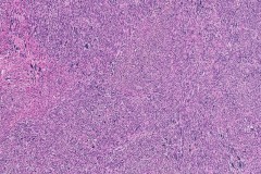 Leiomyoma with atypical cells