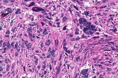 Leiomyoma with atypical cells