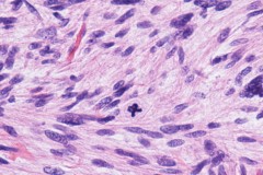Intravascular leiomyosarcoma