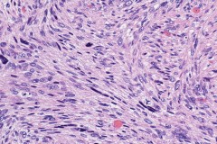 Intravascular leiomyosarcoma