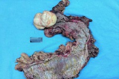 Submucosal lipoma of the colon