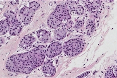 Lobular carcinoma in situ of the breast