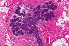 Lobular carcinoma in situ of the breast