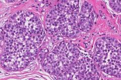 Lobular carcinoma in situ of the breast