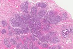 Lobular carcinoma in situ of the breast