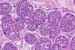 Lobular carcinoma in situ of the breast