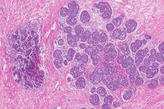 Lobular carcinoma in situ of the breast