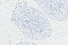 Lobular carcinoma in situ: Loss of e-cadherin expression