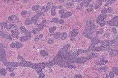 Lobular carcinoma in situ of the breast