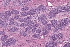 Lobular carcinoma in situ of the breast