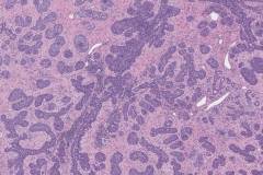 Lobular carcinoma in situ of the breast