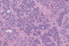 Lobular carcinoma in situ of the breast
