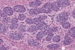 Lobular carcinoma in situ of the breast