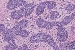 Lobular carcinoma in situ of the breast