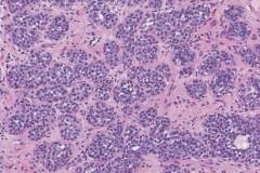 Lobular carcinoma in situ of the breast